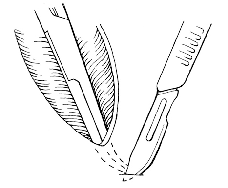 Figure 2-11. Making a subcutaneous tunnel at the distal end of the wound with the tips of forceps. A scapel blade is used to incise the skin over the forceps tips to create a drain emergence site.