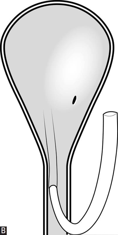 Figure 29-28.B. The ectopic ureteral orifice is catheterized with an appropriate sized urethral catheter