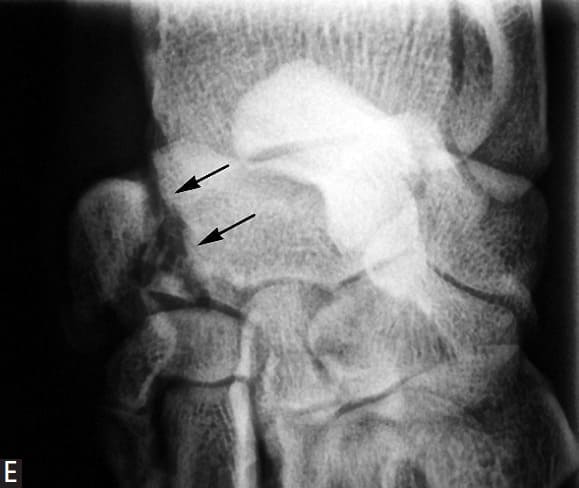 fracture of the palmar process