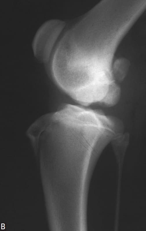 Figure 61-56. Radiographs of stifles with OCD lesions
