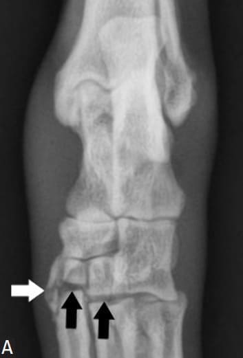 Figure 62-37. In A. fracture of the first tarsal bone can be seen