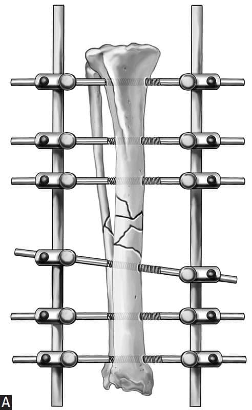Figure 62-8. The frame may be filled out with bilaterally secured fixation pins (maximal type II frame) A