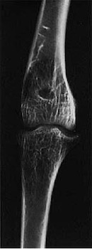 Image 63. An adult swan which was presented with intermittent lameness. The tibiotarsal joint was hot, firm, and swollen. Radiographs indicated joint enlargement, subchondral bone lysis (breakdown) and erosion of the intercondylar space (the smooth surface area at the end of a bone), forming part of a joint. These lesions were suggestive of septic arthritis.