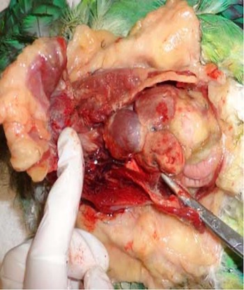 Image 86. Liver abscess in a cockatiel image courtesy Julie Burge; used with permission).