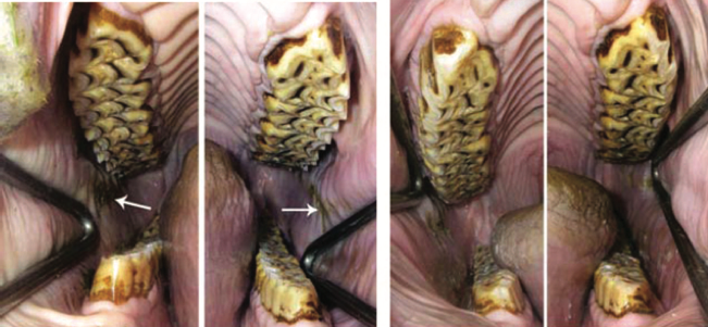 Fig. 1. Quarter Horse gelding, 7-yr-old. Normal development of sharp enamel points on the buccal side of the maxillary cheek teeth and the lingual aspect of the mandibular cheek teeth (left). Buccal mucosal lacerations (arrows). Normal curvature of Spee gives    the false impression of a hook on the lower third molars (311, 411). Conservative management: floating of the anamel points; note that very little rasping of the occlusal surface has occurred.