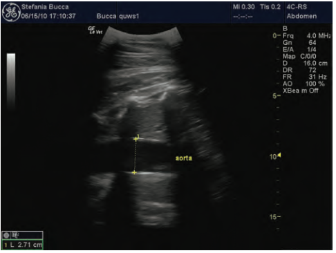 Fig. 2. Transabdominal scan of the cranial chest of a term fetus