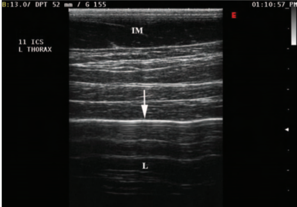Fig. 1. Sonogram of the lung in the left side of the thorax in the 11th intercostal space obtained from a normal horse. Notice the hyperechoic line at the visceral pleural surface of the lung (arrow) casting the multiple reverberation artifacts. L, lung; IM, intercostal musculature.