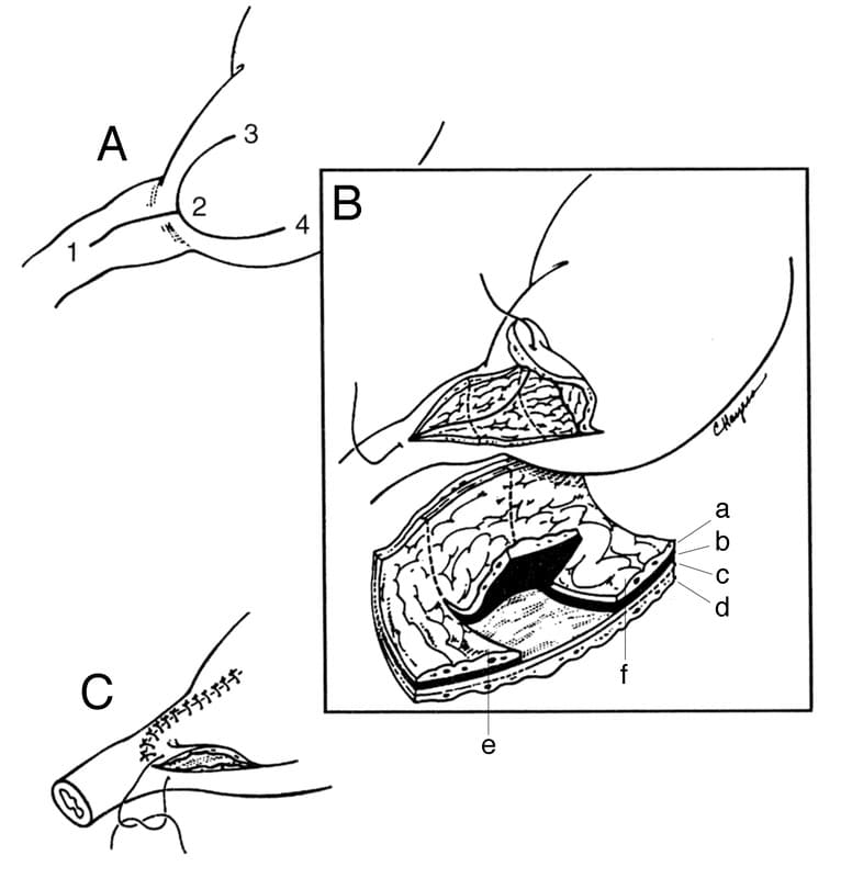 Figure 19-7. Y-U Antral Flap Pyloroplasty