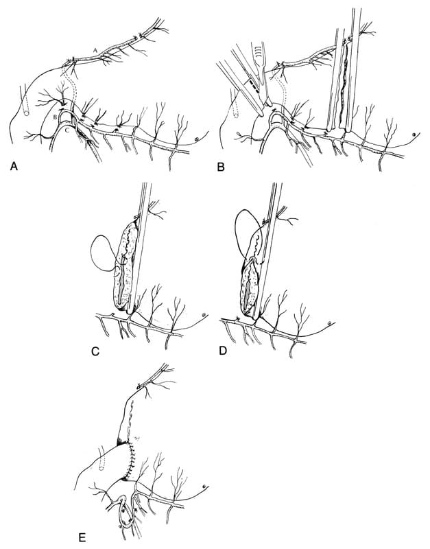Figure 19-8. Gastroduodenostomy (Billroth I)- Hand suturing