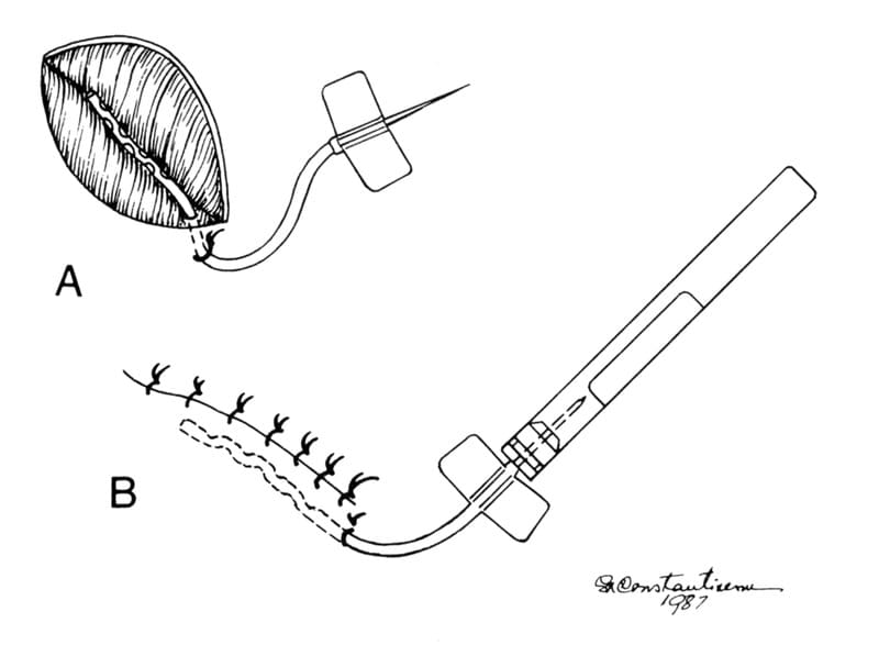 Figure 2-15. Placement of a closed suction drain in a wound. A. The fenestrated portion of the drain is inserted into the wound through a small opening near the distal end of the wound. The tube is secured to the skin with a simple interrupted nonabsorbable suture. B. The wound is closed. The needle on the tube is inserted into a 5 or 10 mL evacuated blood collection tube.