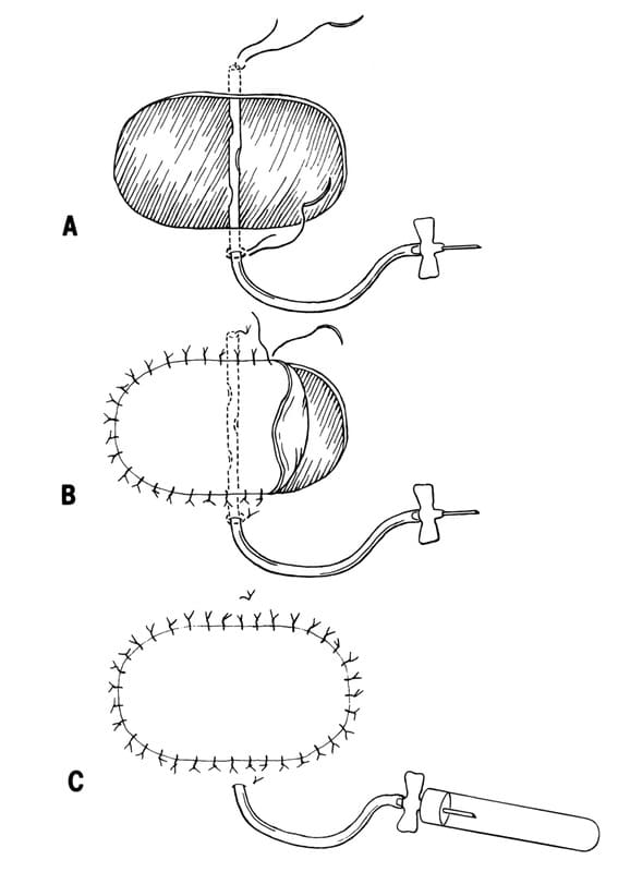Figure 2-16. Placement of a closed suction drain under a skin graft. A. A butterfly catheter with the Luer adapter removed and the tubing fenestrated is placed across the wound bed before the graft is placed. The proximal end is secured with a simple interrupted suture placed through skin, catheter, and skin again. A pursestring suture is used to secure the distal end of the tubing to the skin. B. The graft is sutured into place over the drain. C. The needle on the catheter is inserted into a 5 or 10 mL eva