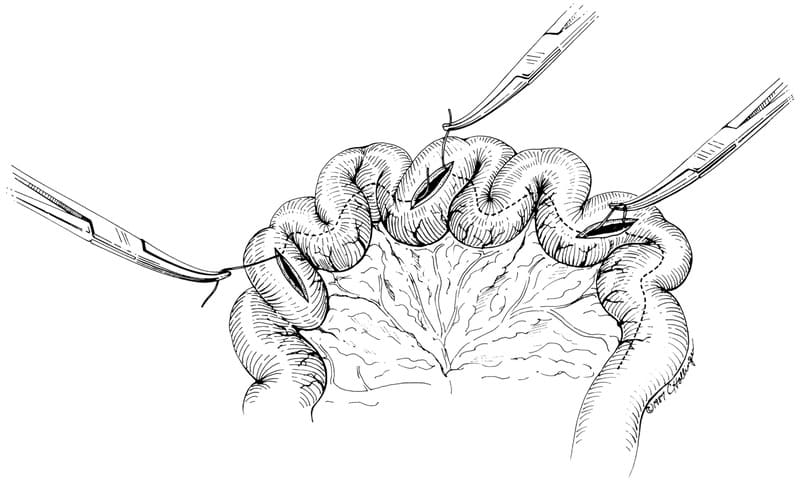 With a linear foreign body (e.g., a piece of string), multiple enterotomies usually are required.