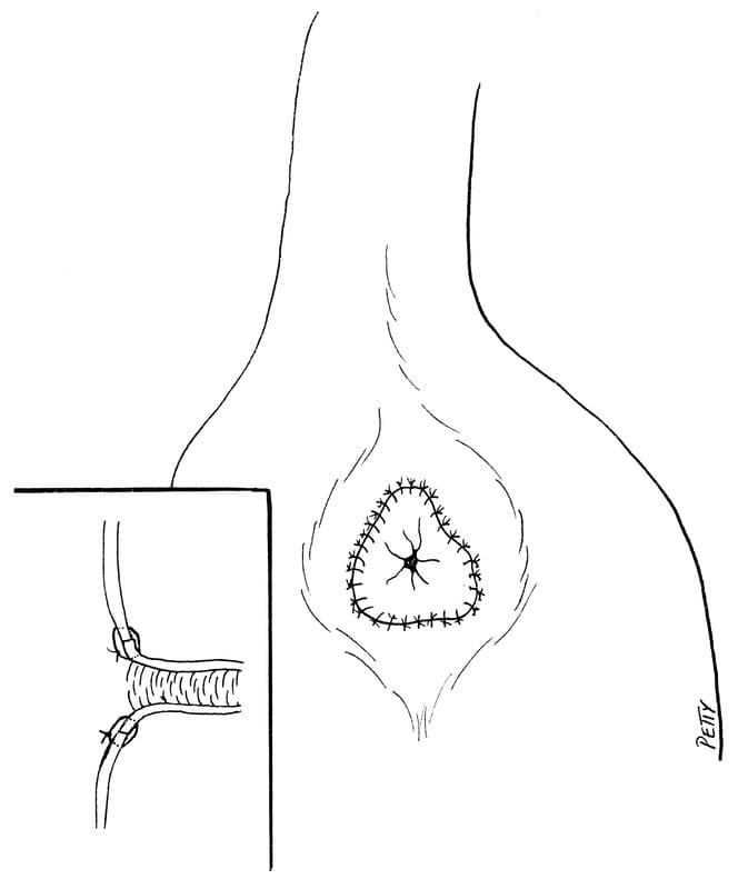 After apposing the deep subcutaneous tissues with simple interrupted sutures the rectal mucosa is apposed to the skin with simple interrupted sutures