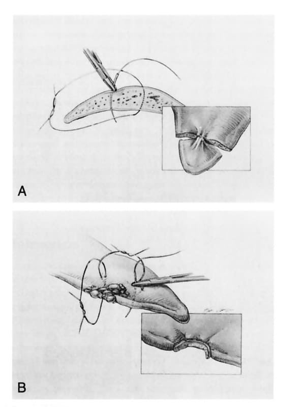 Figure 21-2. Interlocking sutures of an absorbable material are pre-placed to isolate the proposed biopsy site