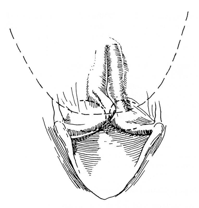 Severe collapse of the arytenoid cartilages in conjunction with an elongated soft palate (dorsal dashed line) and eversion of the laryngeal saccules (ventral dashed lines