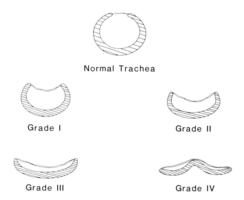 Figure 26-1. Classification of collapsed trachea