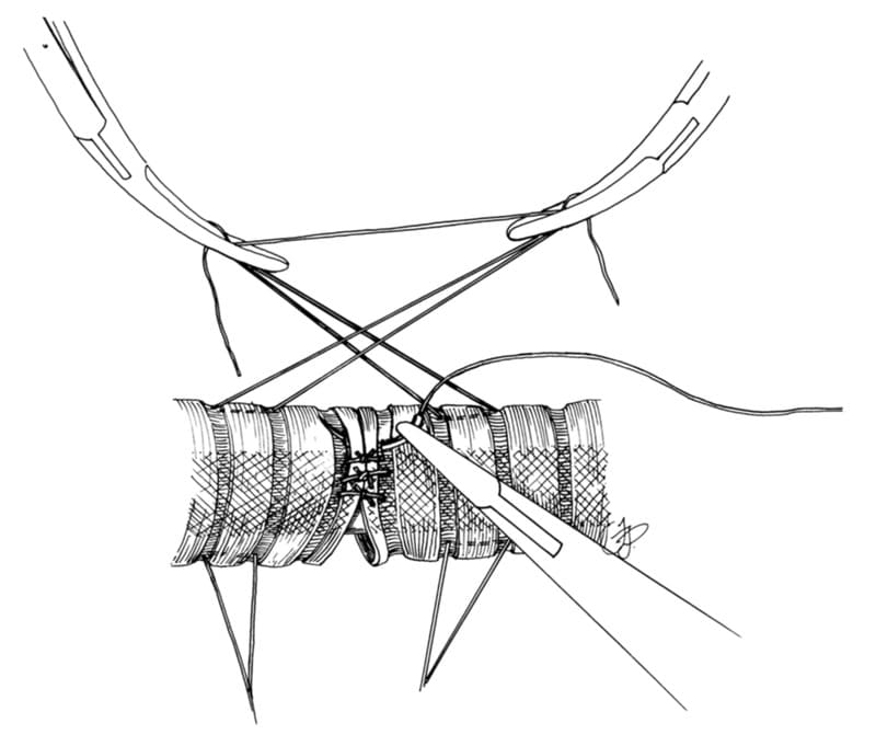 Figure 26-15. The primary anastomosis begins on the ventral aspect