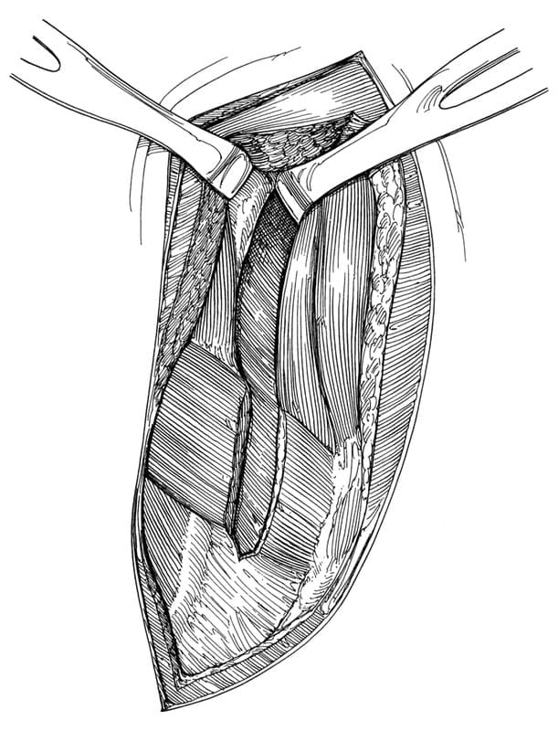 Figure 27-2. Intercostal thoracotomy