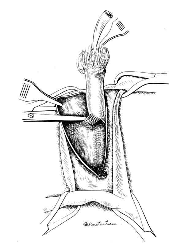 Figure 31-11. The ischiocavernosus muscle is identified and is cut with scissors