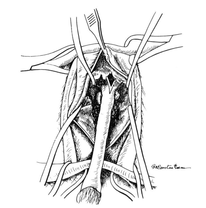 Figure 31-12. Urethral dissection is completed by transecting the V-shaped uterus masculinus