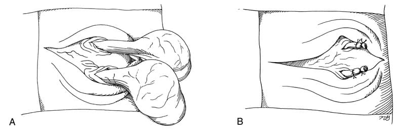 Figure 31-4. A and B. The isolated scrotal skin is removed, and castration is performed