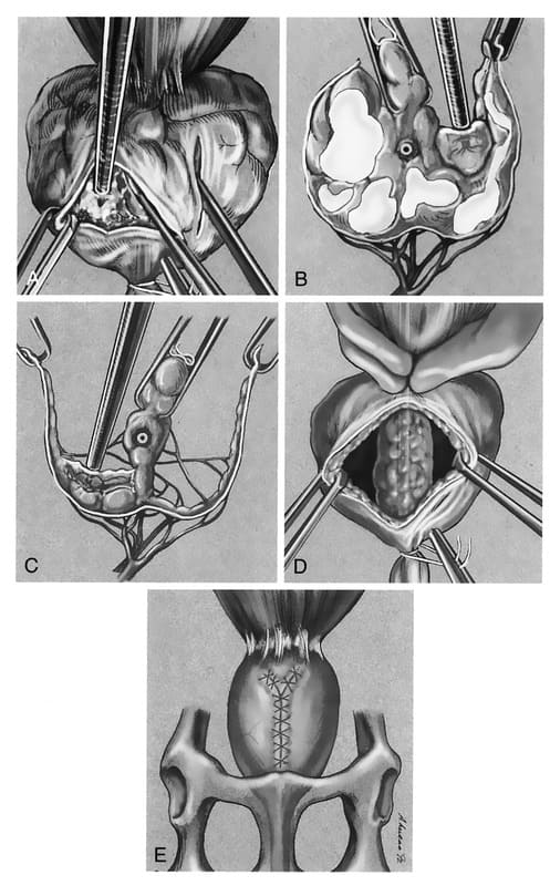 Figure 32-3. A. Ventral view of a partial prostatectomy