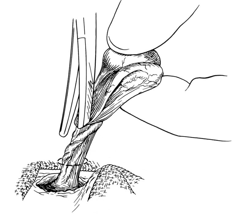 Figure 35-7. Open castration involves opening the parietal tunic of the vaginal process