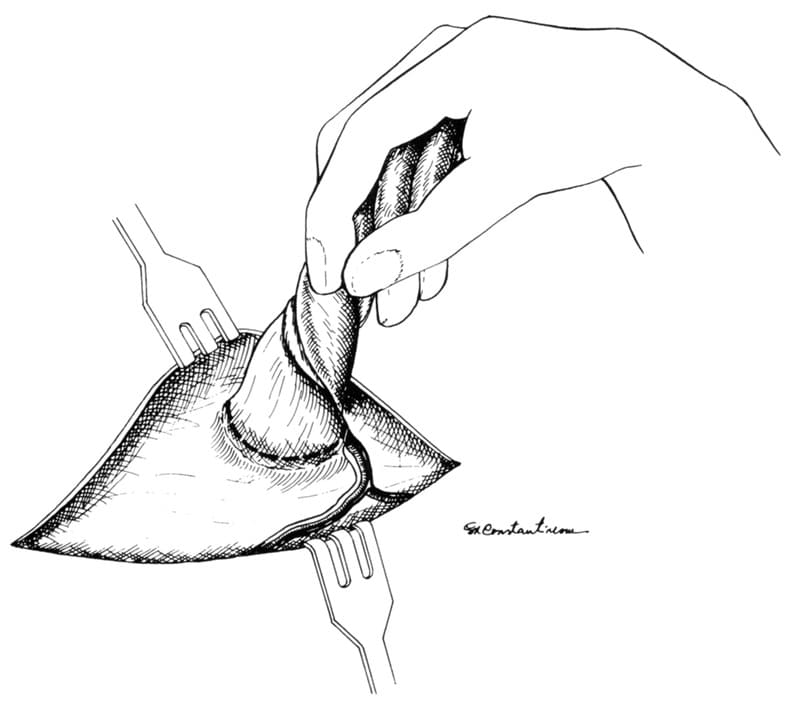 Figure 38-3. The edges of redundant sac are excised