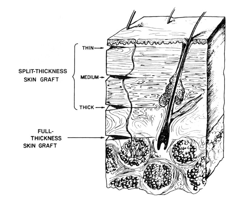 Figure 41-23. Full-thickness skin grafts consist of the epidermis
