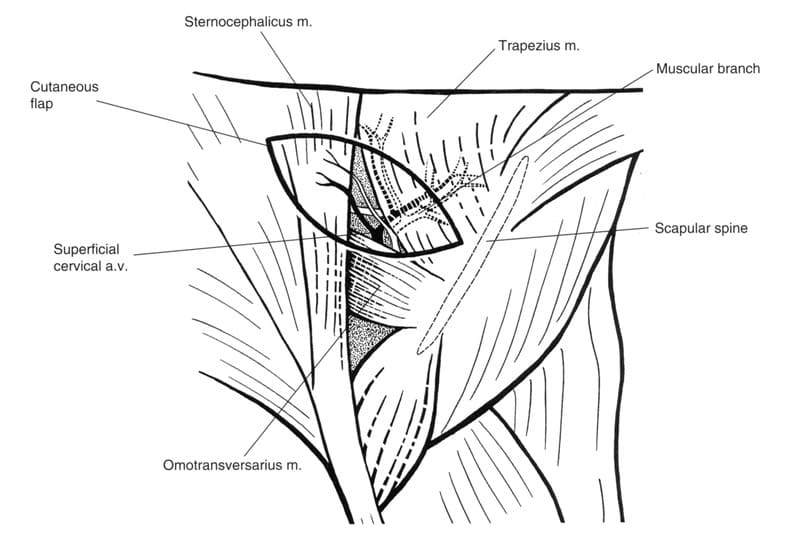 Figure 41-28. The anatomy of the superficial cervical cutaneous free flap is indicated