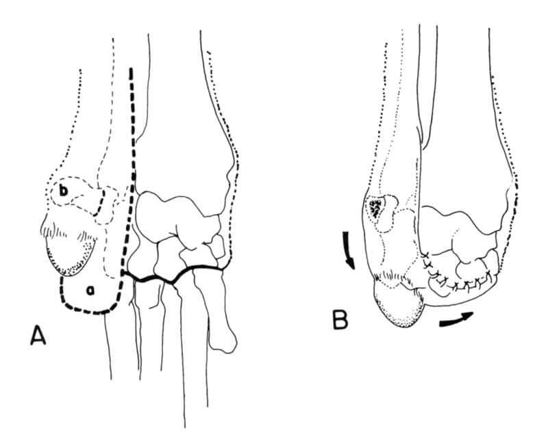 Figure 41-49. Single pedicle carpal pad flap