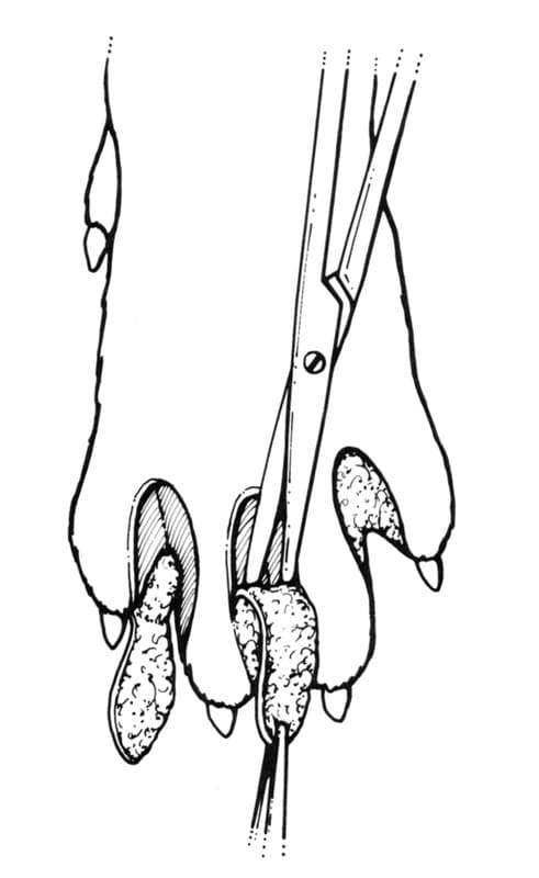 Figure 41-55. Fusion podoplasty