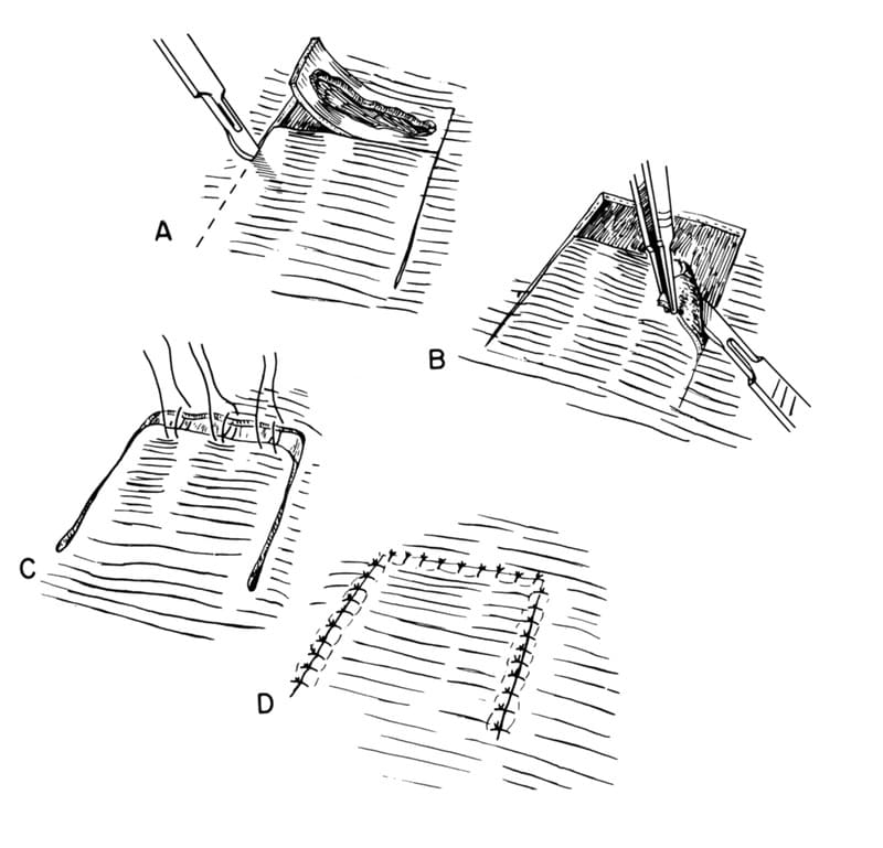 Figure 41-6. Single-pedicle advancement flap