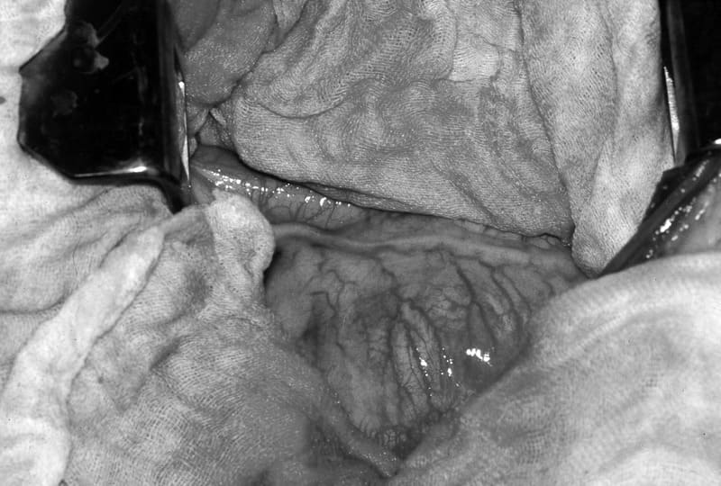 Figure 42-23. A highly vascular pericardial sac as viewed through a right intercostal thoracotomy