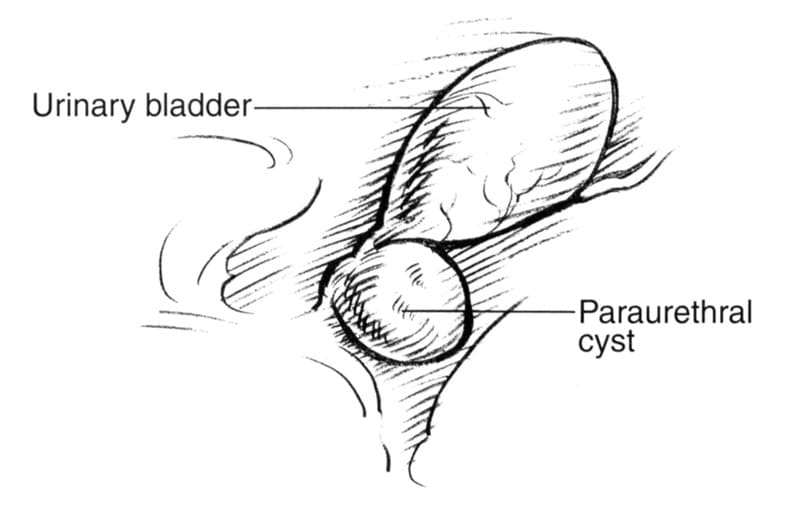 Figure 45-2. A paraurethral cyst around the neck of the urinary bladder