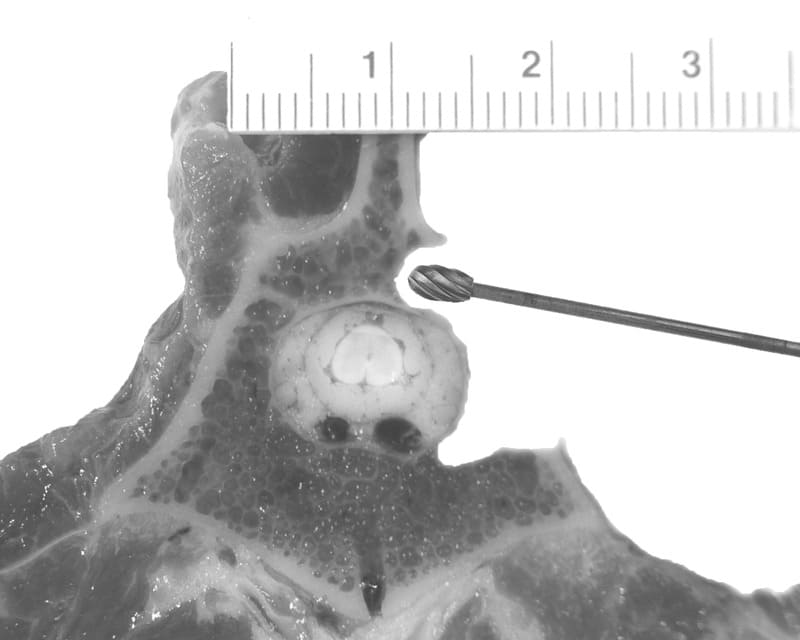 Figure 48-22. The hemilaminectomy can extend dorsally