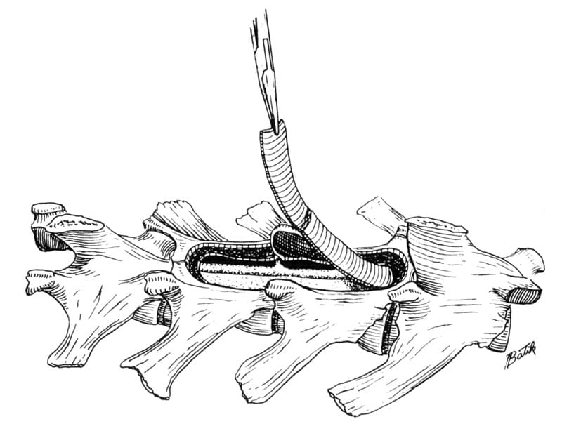 Figure 48-32. The thin shelf of inner cortical bone is grasped with a hemostat and is removed as a unit