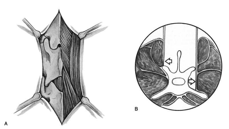Figure 48-33. Muscle elevation for dorsal laminectomy
