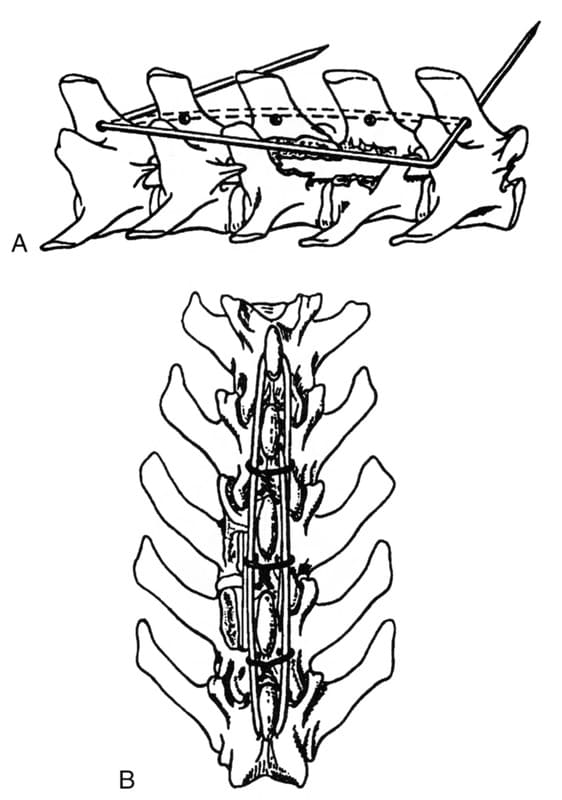 Figure 48-37. A. and B. Spinal stapling using single pin