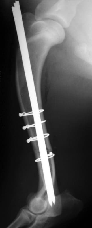 Figure 49-7. B. Lateral post-operative radiograph of repair with intramedullary pins