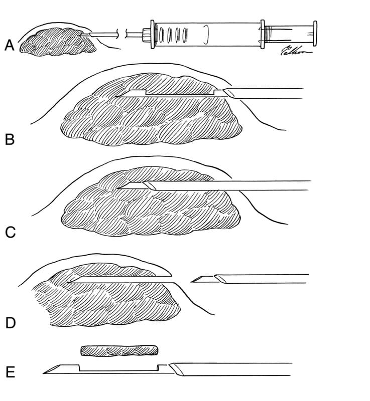 Figure 5-1. Needle core biopsy technique. A. A stab incision is made, and the instrument is inserted through the tumor capsule with the outer sleeve closed over the inner cannula. B. The outer sleeve is held fixed while the inner cannula is thrust forward into the tumor. C. The outer sleeve is pushed forward to slice off the specimen, which is protruding into the trough. D. The instrument is removed closed. E. The inner cannula is exposed, revealing the tissue specimen in the trough. 