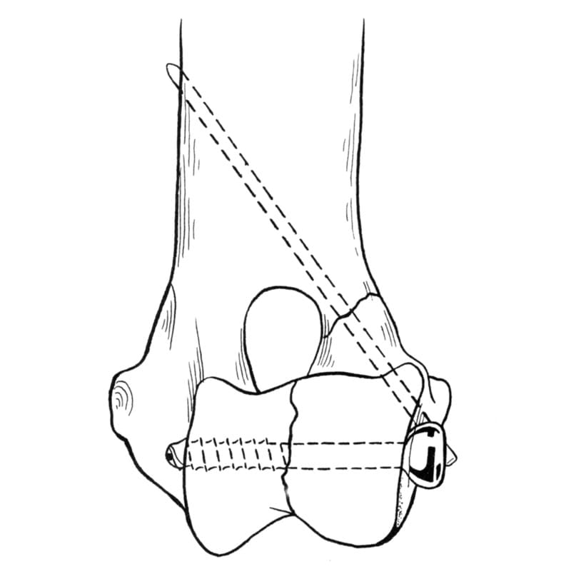 Figure 51-3. A cancellous screw and Kirschner wire are used for repair of a lateral condylar fracture