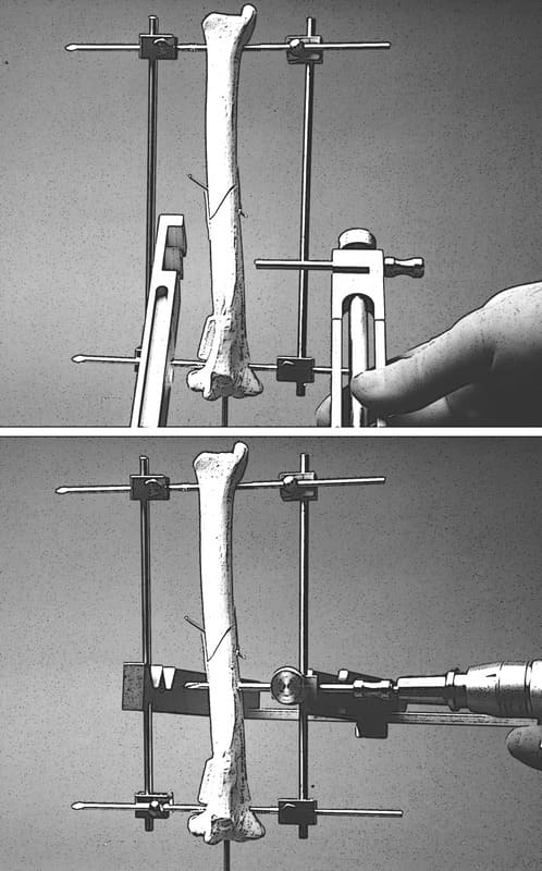 Figure 53-22. Application of bilateral fixator frames