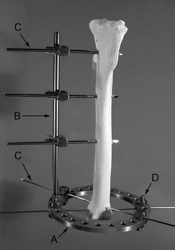 Figure 53-53. A basic HCF allows stabilization of small juxta-articular bone segments