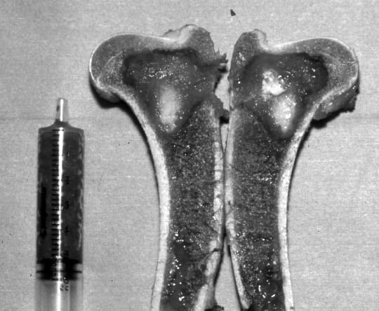 Figure 54-6. Split section of the humerus after collection of a cancellous bone graft
