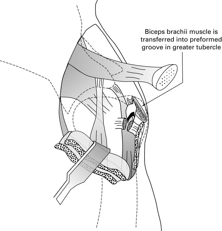 Figure 55-12. The biceps brachii tendon is transferred into a bone tunnel