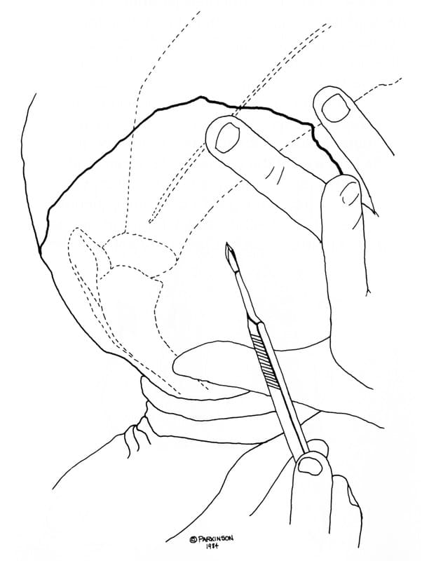 Figure 55-13. The skin incision is made from the midpoint of the scapular spine