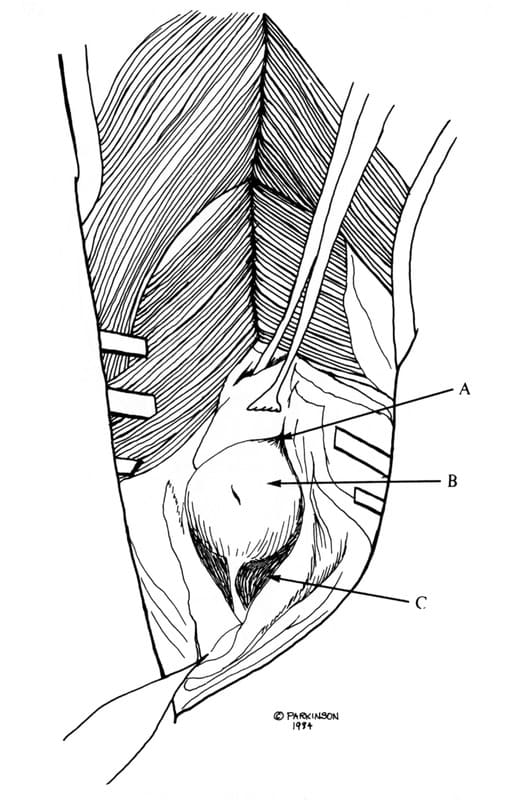 Figure 55-24. Joint capsular incision exposes the caudal glenoid (A)