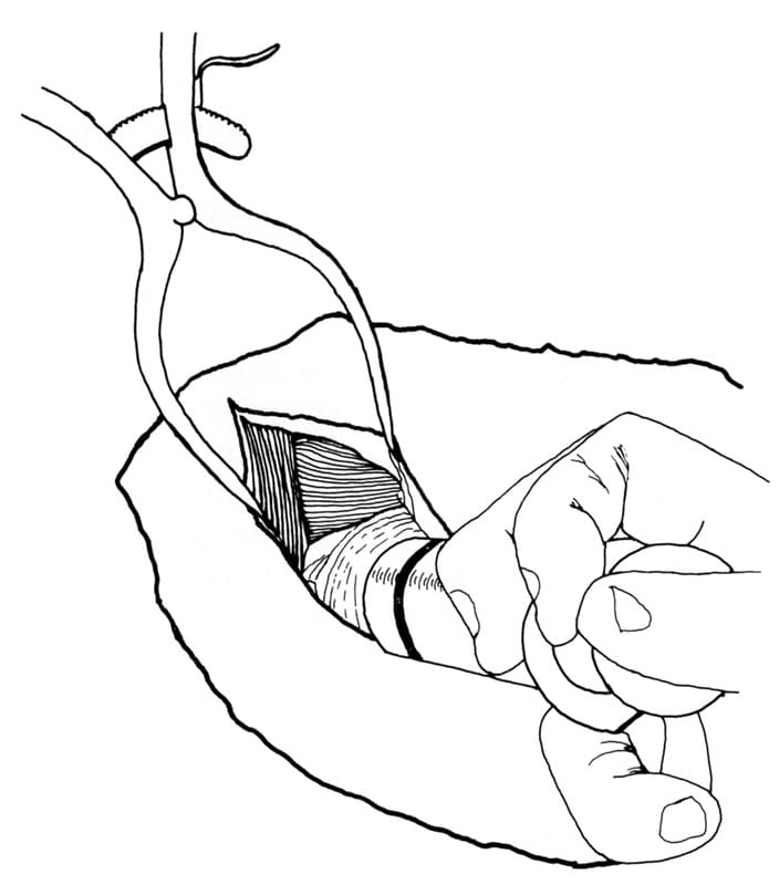 Figure 55-27. The caudal shoulder joint is flushed to remove debris