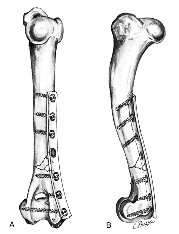 A bone plate positioned on the caudomedial surface of the shaft and the medial epicondyle for repair of distal shaft fractures with a comminuted medial cortex